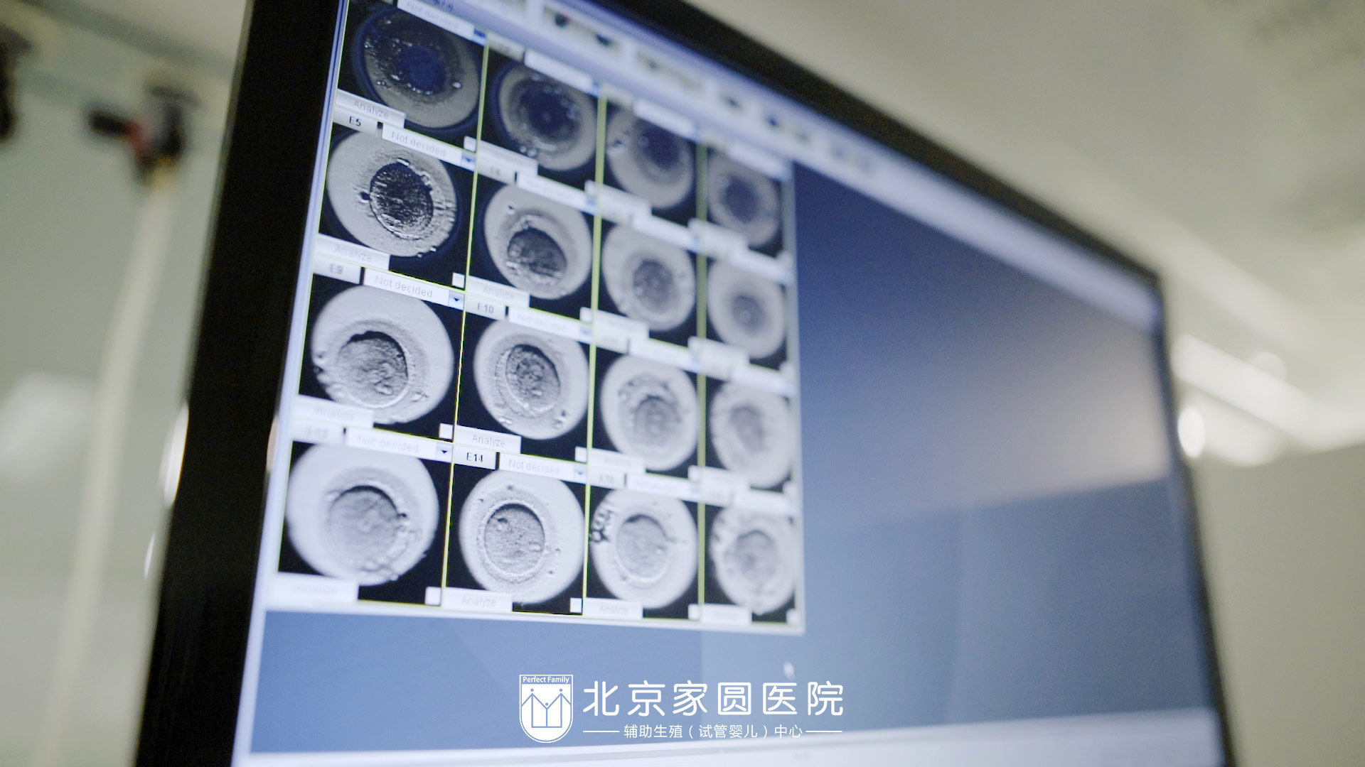 想做供卵做试管婴儿宫颈分离怎么办-宫颈分离要注意什么